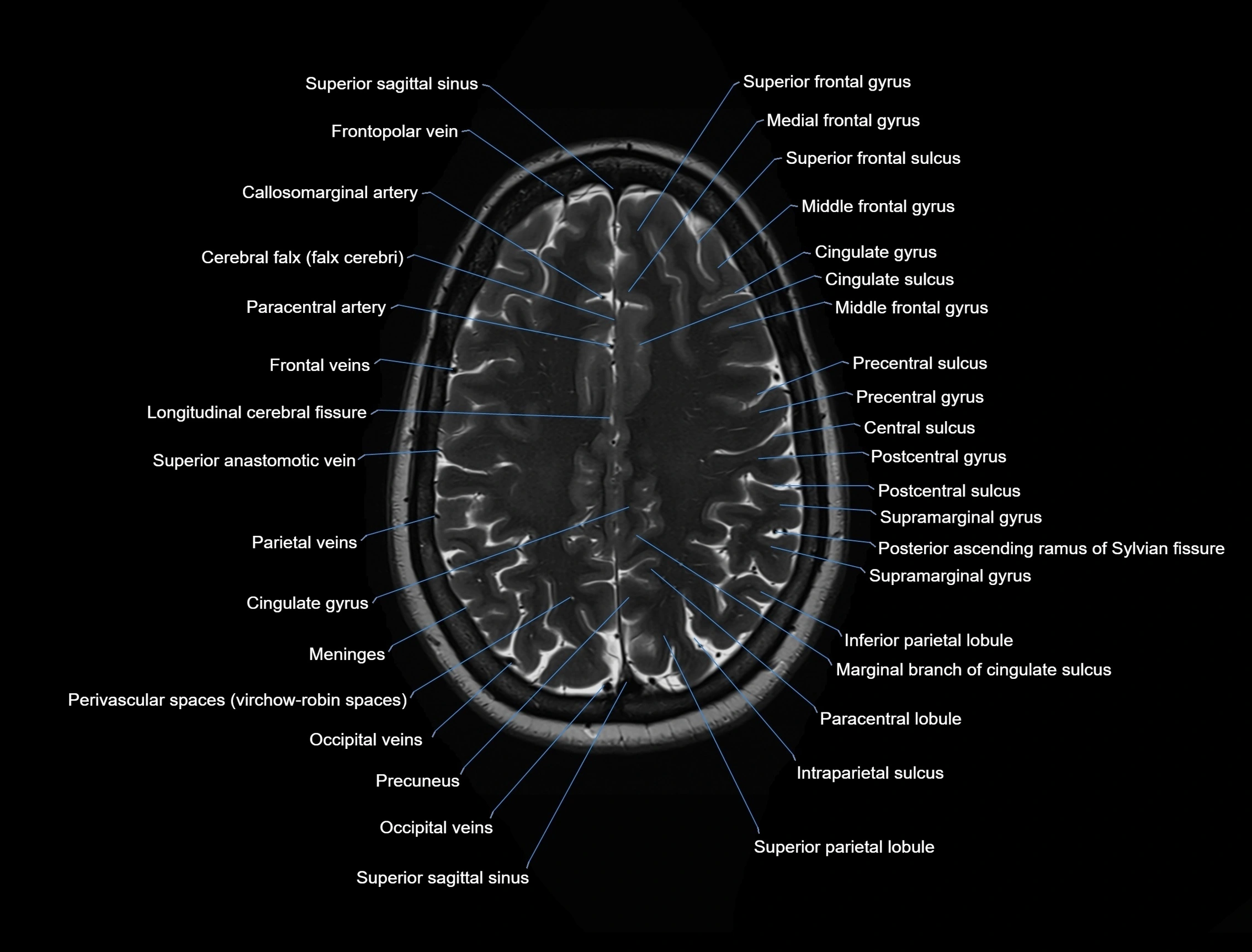 MRI Brain axial cross sectional radiology anatomy 3T image  -img-00001-00043.webp